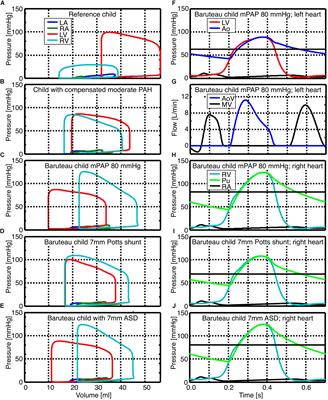 Potts Shunt to Be Preferred Above Atrial Septostomy in Pediatric Pulmonary Arterial Hypertension Patients: A Modeling Study